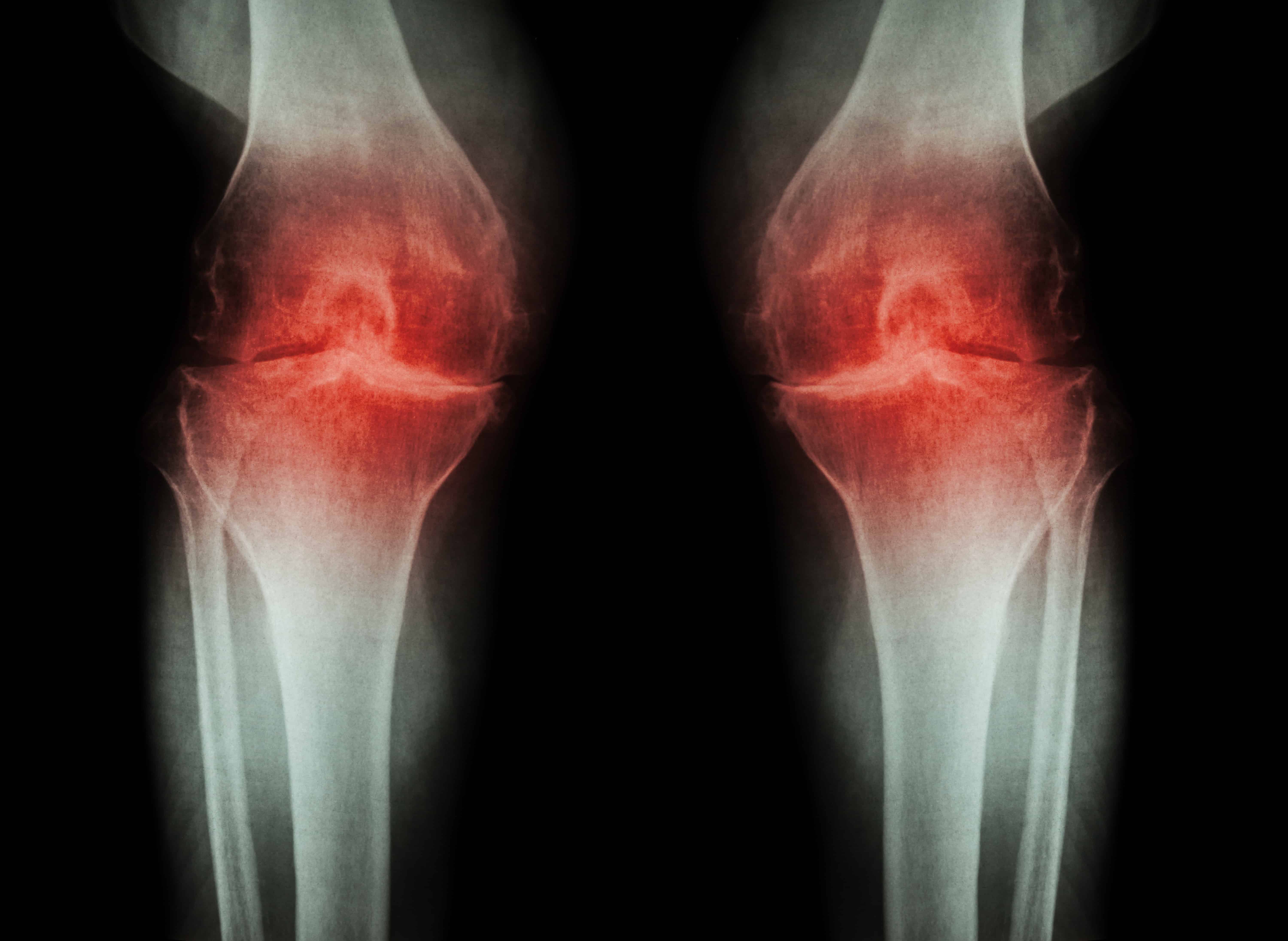 Гемартроз коленного сустава рентген