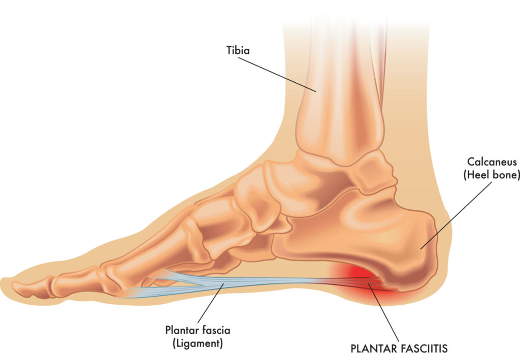 Plantar Faciitis