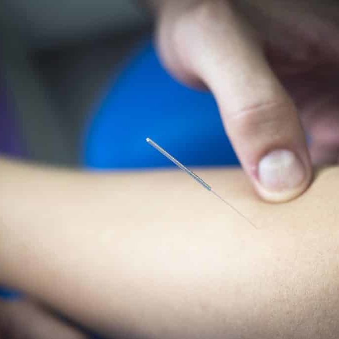 DRY NEEDLING